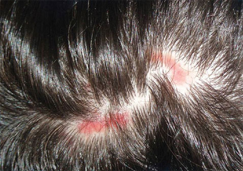 一些患有红斑狼疮的人一丛一丛地掉头发.更常见的是,头发慢慢变薄.