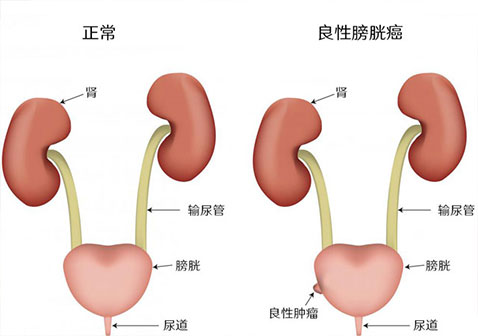 良性膀胱癌的早期症状有哪些?