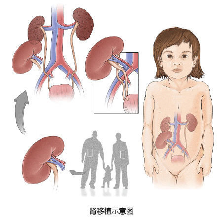 肾移植过程示意图