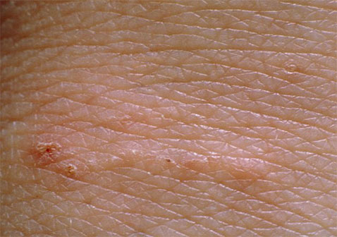 疥疮是什么样子疥虫感染初期小红点和爬过的痕迹症状