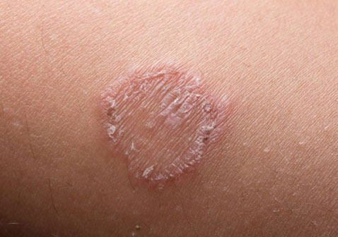 癣是皮肤癣的简称,它是一种皮肤真菌感染.