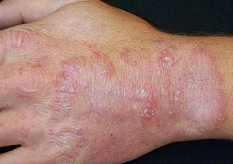 真菌感染皮肤病图片对照大全种类及症状