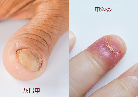 对比图片灰指甲和甲沟炎灰指甲是一种影响指甲或脚趾甲真菌感染的疾病