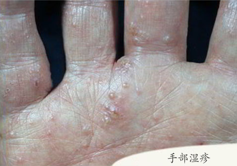 湿疹图片初期症状图片大全:耳朵,手掌手背,疱疹