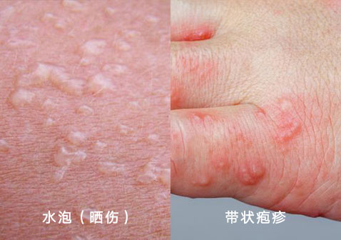 水泡和疱疹的区别图片