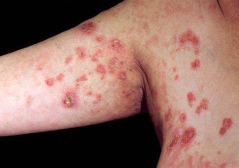 疱疹性皮肤病图片