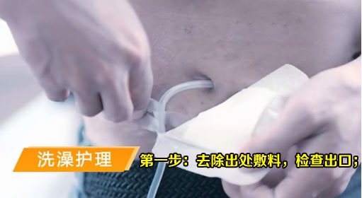 腹膜透析洗澡护理-第一步：洗澡前去除出处敷料，检查出口