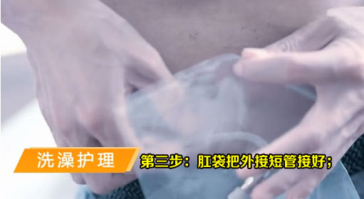 腹膜透析洗澡护理-第三步：肛袋把外接短管接好；