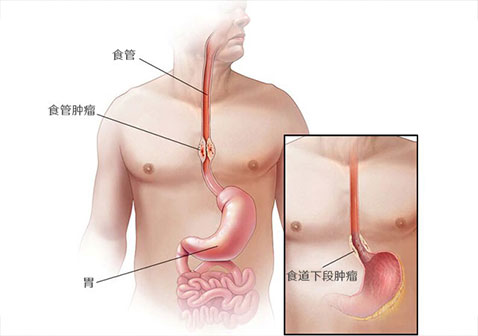 barrett食管与癌症