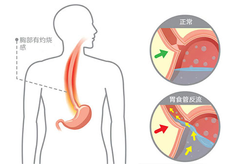 barrett食管与胃食管反流病的关系图