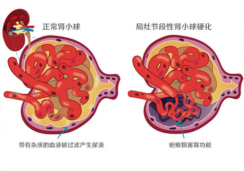 局灶节段性肾小球硬化FSGS是肾小球疾病中最严重的