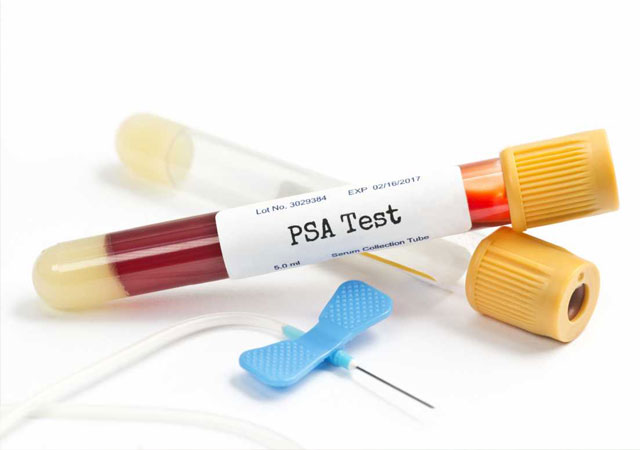 前列腺特异性抗原PSA血液检查