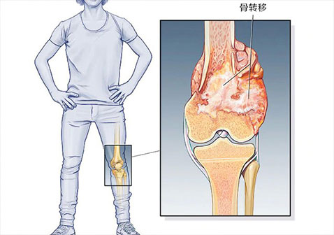 癌症或晚期4期膀胱癌骨转移早期症状和体征迹象有哪些？