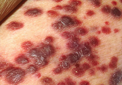 与艾滋病相关的皮肤肉瘤症状图片