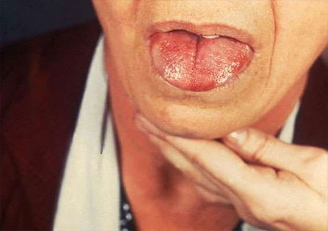 与艾滋病相关的舌头症状图片