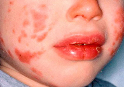 川崎病1期早期症状嘴唇红肿剥落