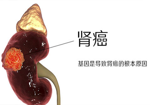 肾癌是什么原因引起的？