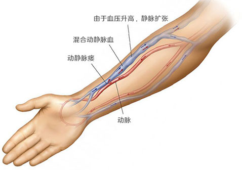 健康动静脉瘘AV什么样多长时间愈合成熟发红手麻木并发症