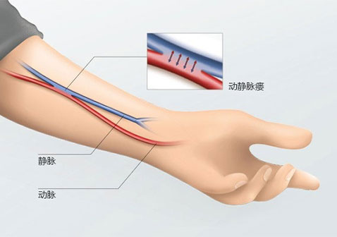 手臂透析做动静脉瘘图片