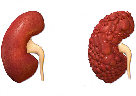 遗传导致多囊肾病的形成