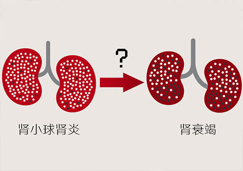 儿童肾小球肾炎发展到肾衰竭需要多久