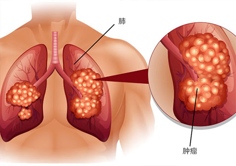 肺癌疼痛的最佳治疗方法是什么？