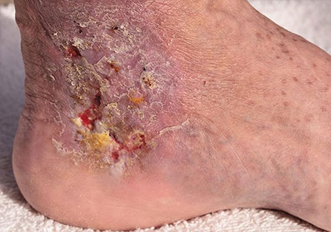 蜂窝织炎在更严重的情况下，可能形成水疱并且皮肤可能分解