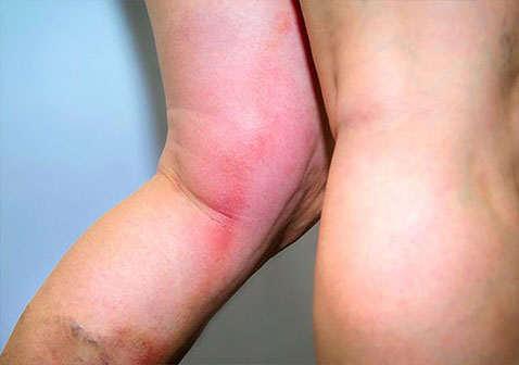 腿部红肿的皮肤可能由蜂窝织炎引起
