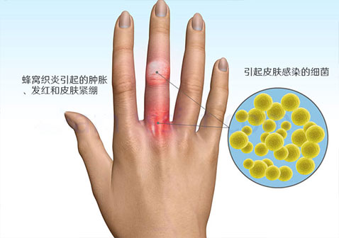 蜂窝织炎是怎么引起的示意图