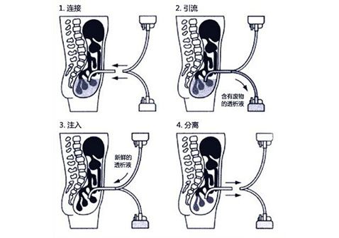 腹膜透析主要操作流程图
