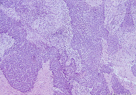 显微镜病理图像显示肛门和直肠浸润性鳞状细胞癌