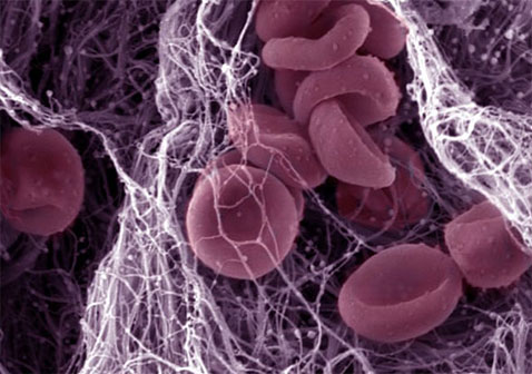 血细胞和血凝块