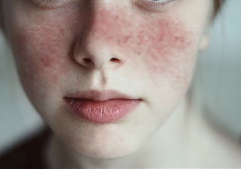 常见皮肤病图片及名称红斑狼疮