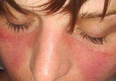 红斑狼疮早期症状蝴蝶疹真实图片