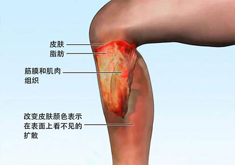 如图-坏死性筋膜炎是什么