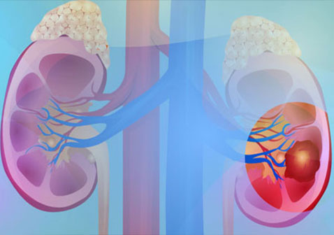 活了40年得了早期肾癌怎样治疗能治愈？