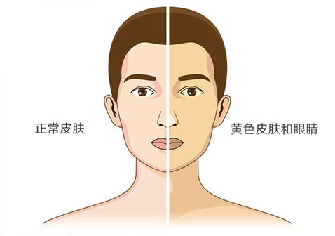吉尔伯特综合征也叫先天性非溶血性黄疸