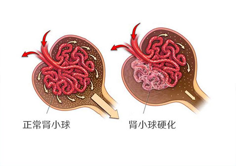 局灶节段性肾小球硬化在一定程度上能治好（缓解）