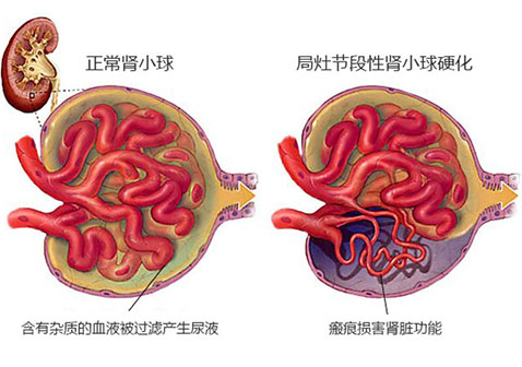 局灶节段性肾小球硬化发展过程图