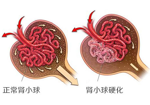 局灶节段性肾小球硬化有治愈的方法吗或一直有这种病？