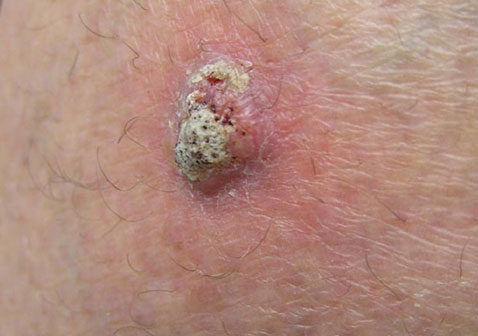 鳞屑皮肤病图片鳞状细胞癌