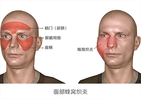 面部蜂窝织炎症状图示