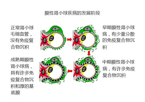 膜性肾小球病的发展阶段