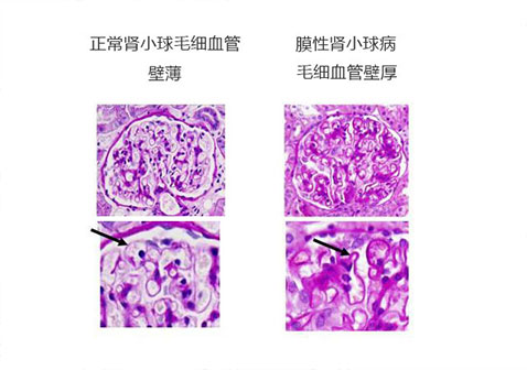 正常肾小球与膜性肾小球病对比图