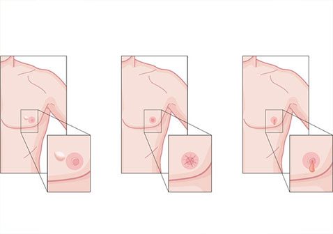 男性乳腺癌早期症状信号图