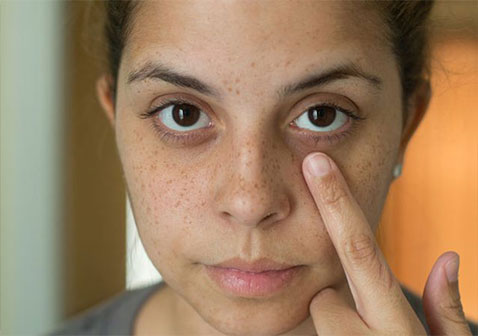 尿毒症面容特征-干燥皮肤，眼睛周围黑暗