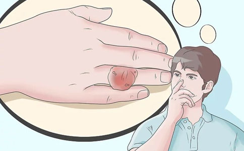 尿酸高有哪些体征征兆和症状？