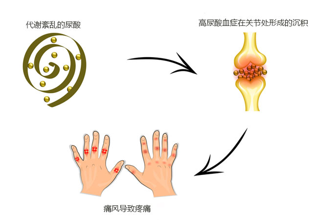 尿酸、高尿酸血症、痛风形成关系图