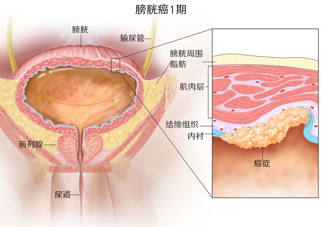 膀胱癌1期