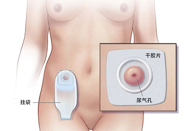 膀胱全切术过程及术后挂袋图片